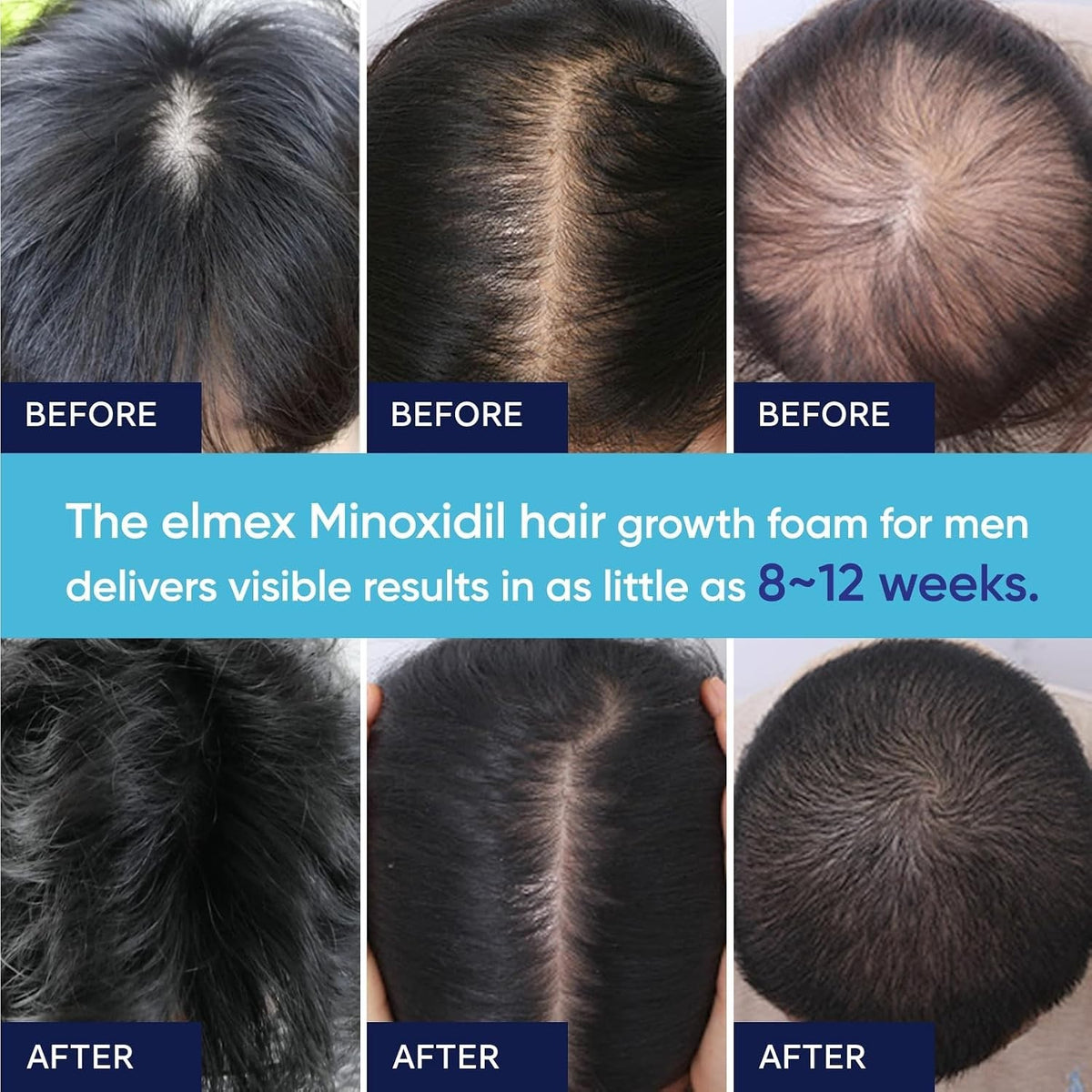 5% Minoxidil Foam for Hair & Beard Growth