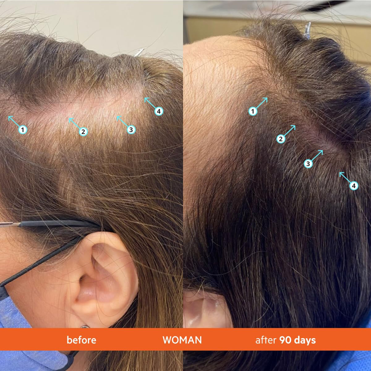 Revita Hair Density Shampoo for Thinning Hair, color safe, 205 mL,