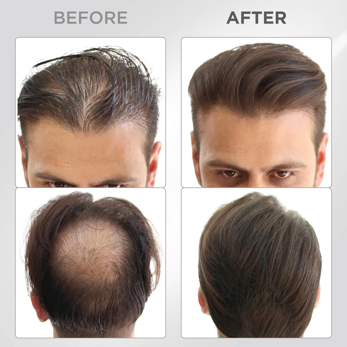 Hair Building Fibers for Thinning Hair - Dark Brown, 25g