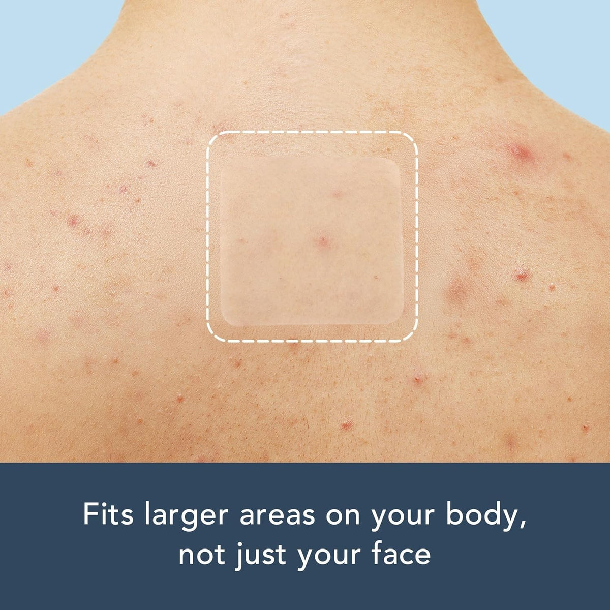 Large Hydrocolloid Pimple Patches - 50mm Absorbent Blemish Cover for Face & Body