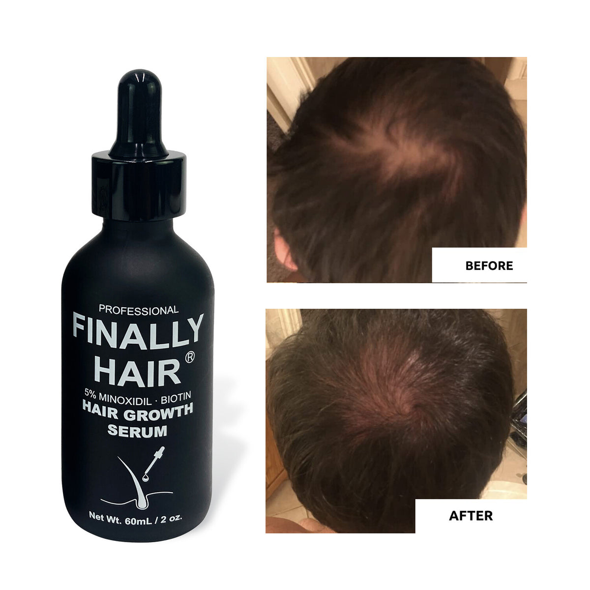 Minoxidil 5% Hair Growth Serum with Biotin & Collagen