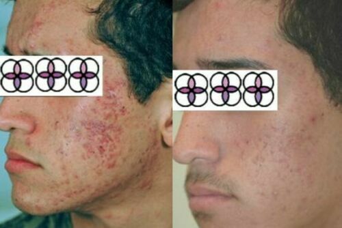 Glycolic Acid Face Cream for Acne and Scar Treatment - 10-70% Strength, 0.4oz