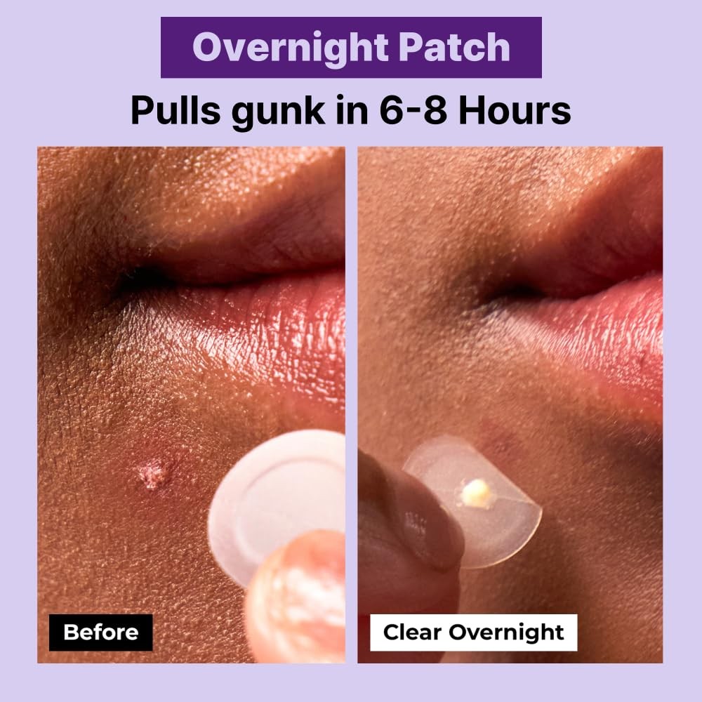 Acne Pimple Patches Set - Invisible, Waterproof, 3 Sizes for Spot Treatment