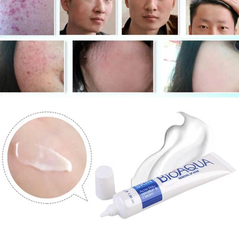 Acne Treatment Cream for Blemishes & Spots - 30ml Face Skin Care