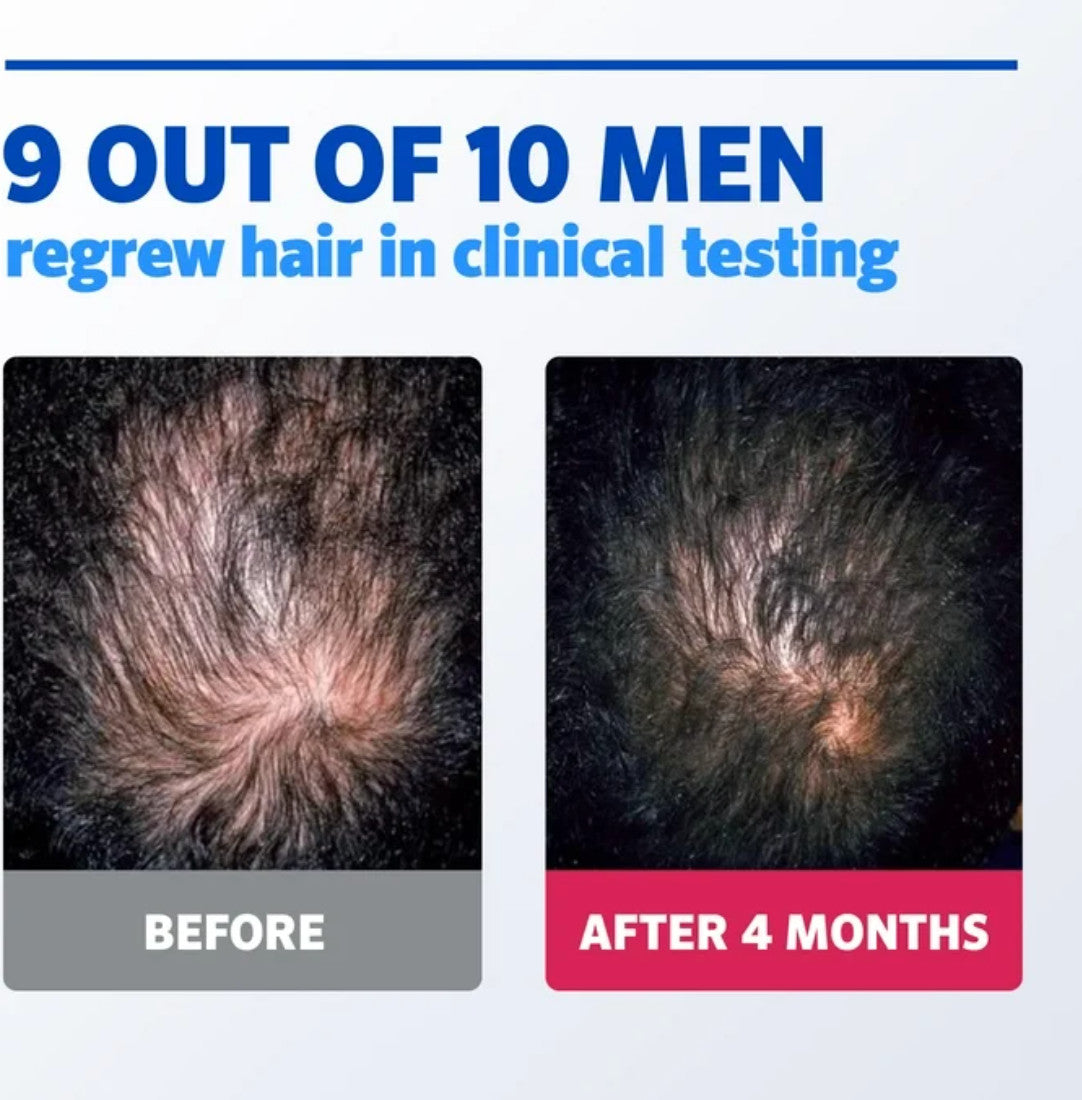 5% Minoxidil Foam Hair Regrowth Treatment for Men - 3 Month Supply