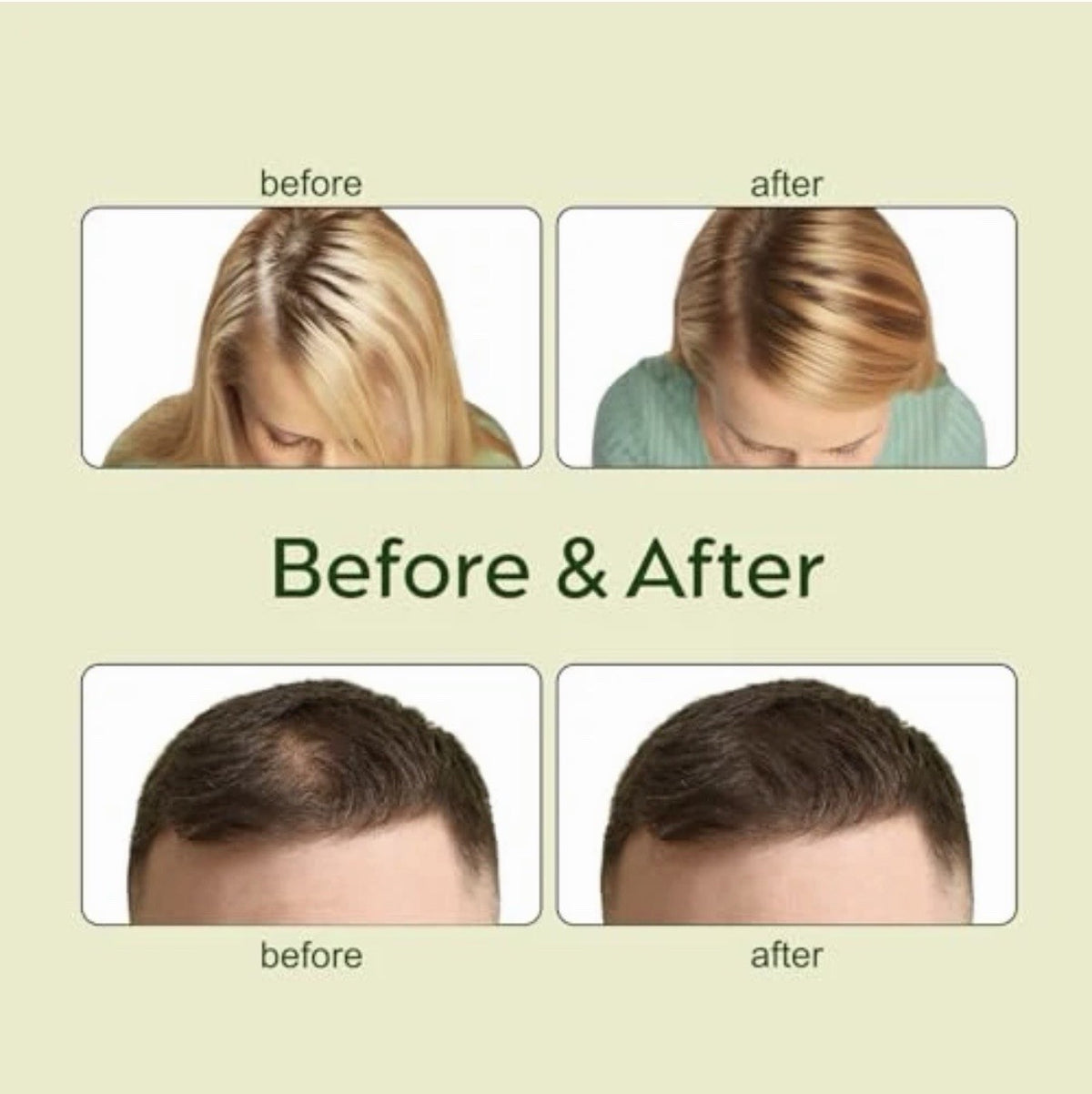 Hair Growth Oil Kit with Dermaroller - 2x30ml Botanical Blend