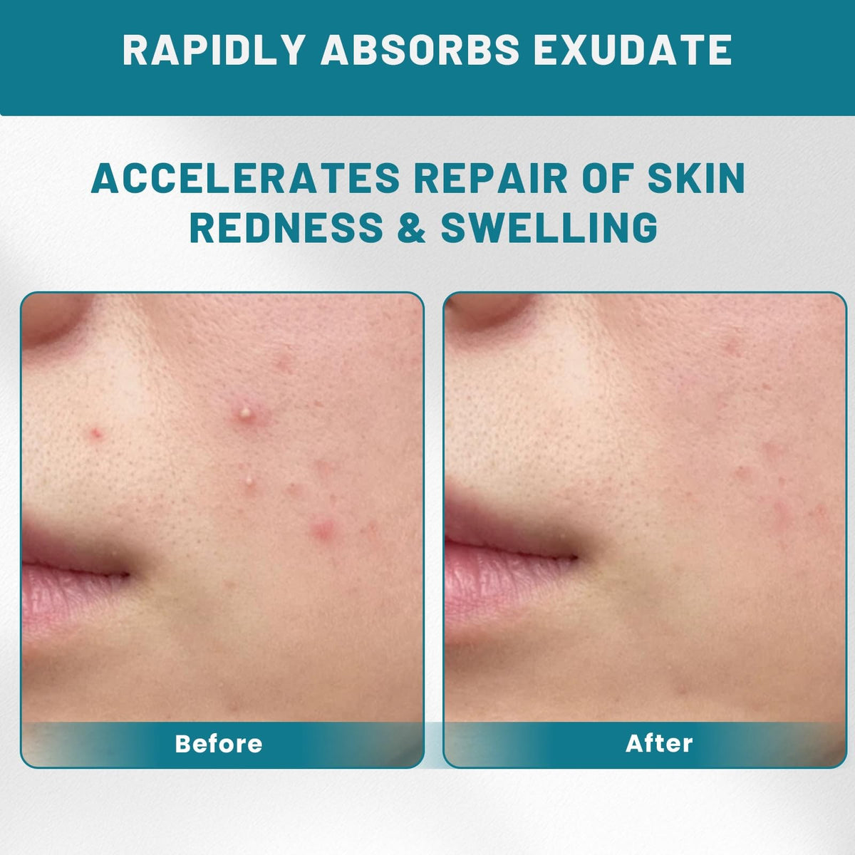 Acne Patch Roll 0.66in x 75in Hydrocolloid