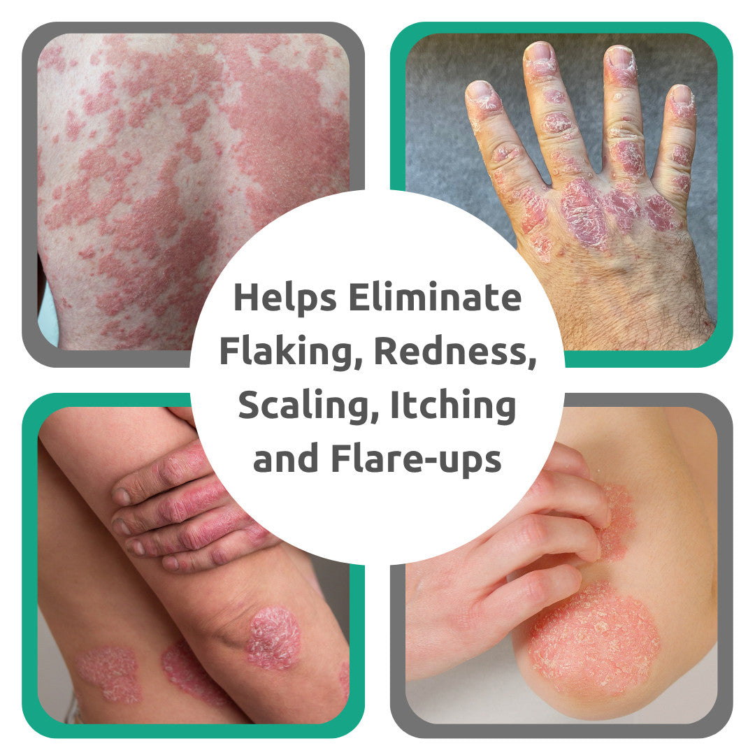 Dr. Blaine's Revitaderm Psoriasis Formula Reduced Odor 4 oz Pack of 3