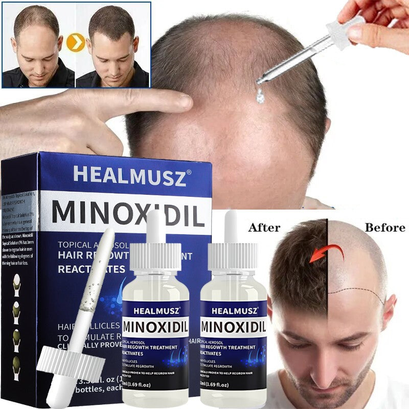 Minoxidil 5% Extra Strength Hair Regrowth Treatment for Men