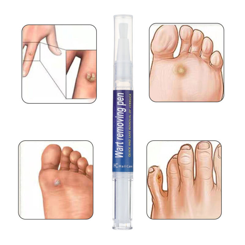 Painless Wart Remover Pen Set - Safe Skin Tag and Mole Treatment, 5 Pack