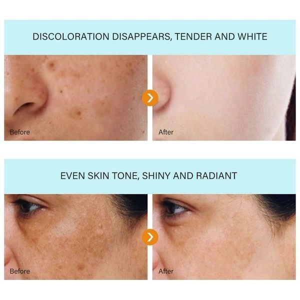 Dark Spot Remover Cream for Face & Body - Anti-Aging & Hyperpigmentation Treatment - 2 Pack