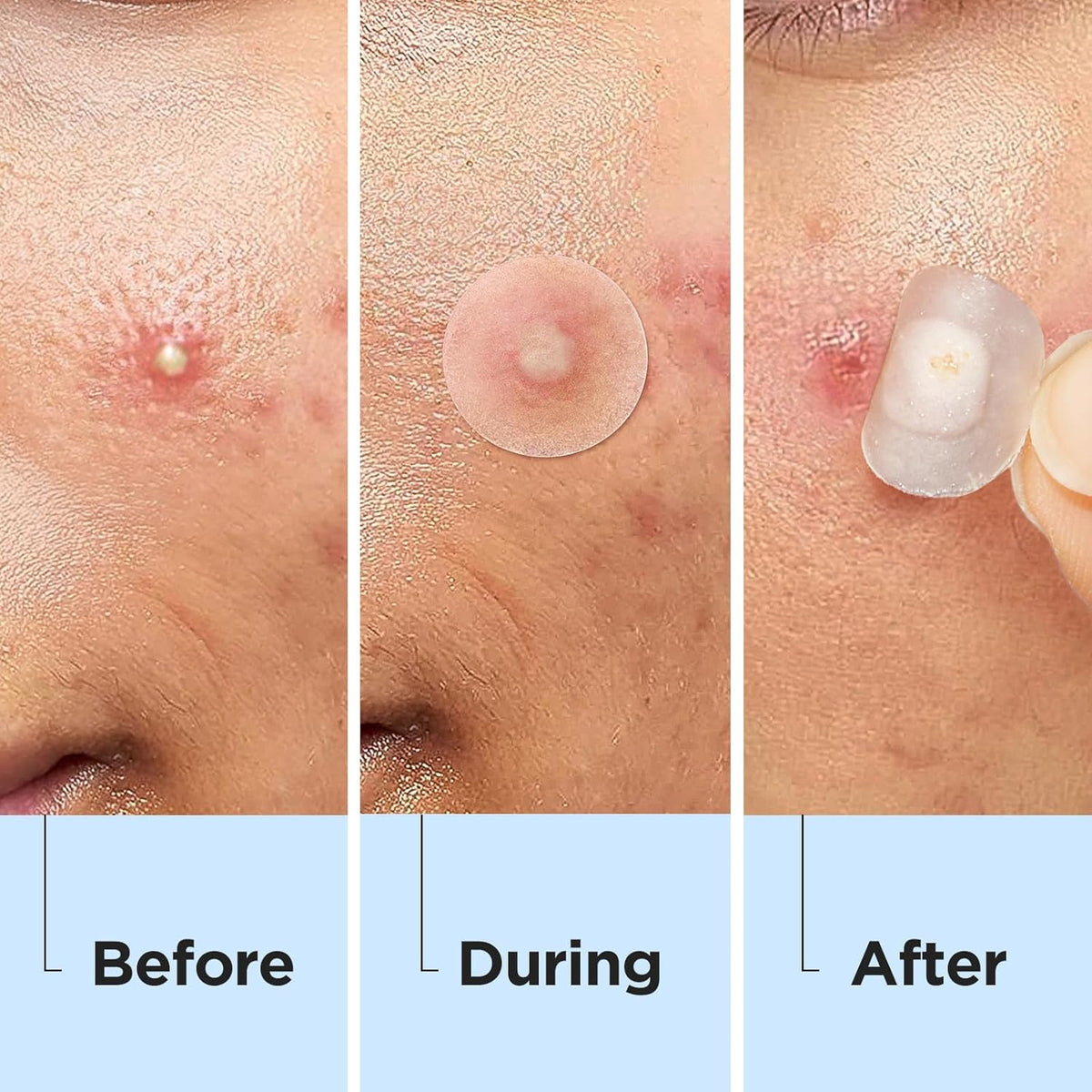Invisible Hydrocolloid Acne Patches 330 Count - Discreet Spot Treatment