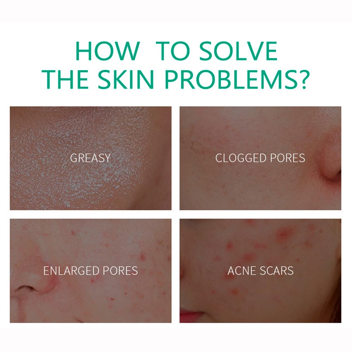Anti-Acne Cream for Oily Skin Pores & Scar Reduction 20g