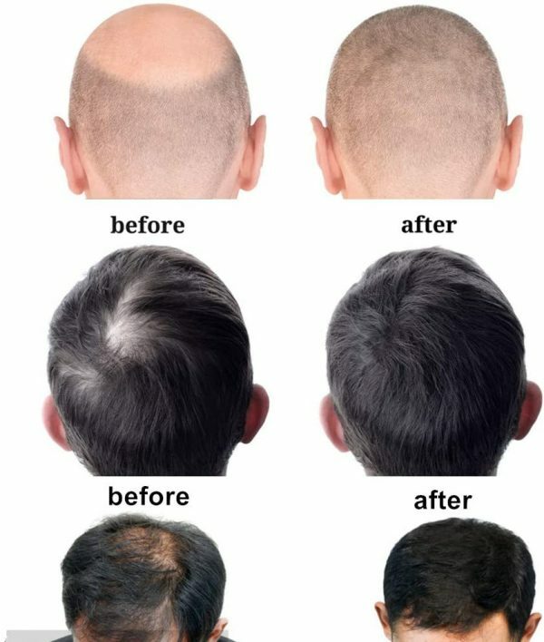 Infrared Red Light Therapy Helmet for Hair Loss & Regrowth