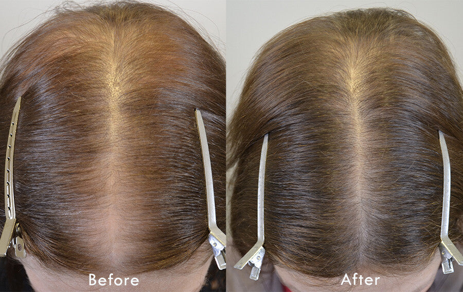 Hair Loss ReGrowth Treatment Oil with 16 Organic Oils
