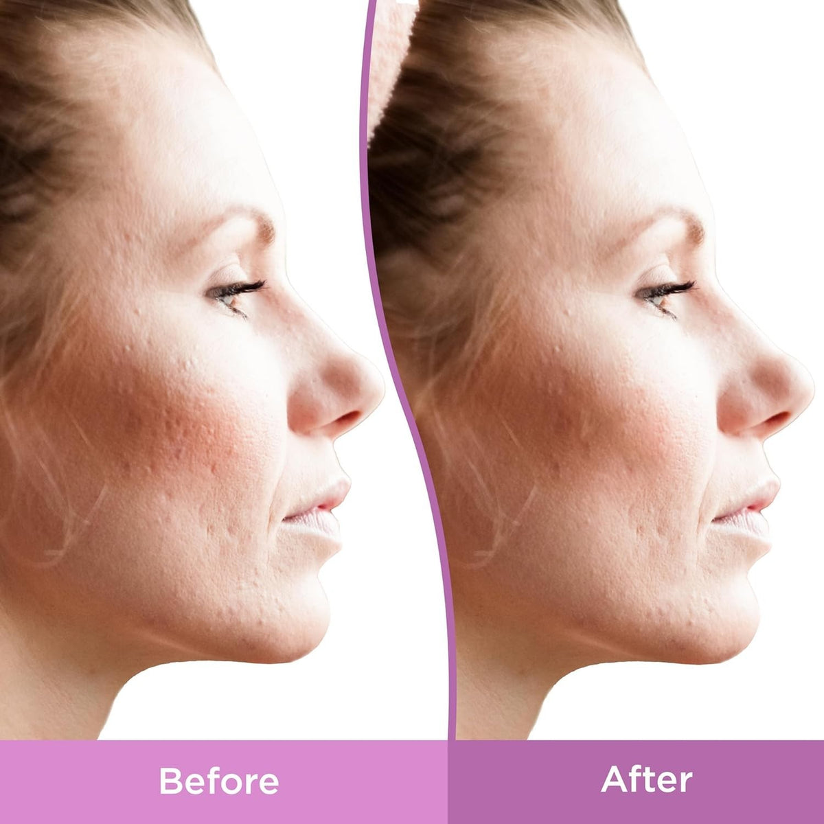 Gentle Acne Scar Treatment Gel for Sensitive Skin - 1 Oz