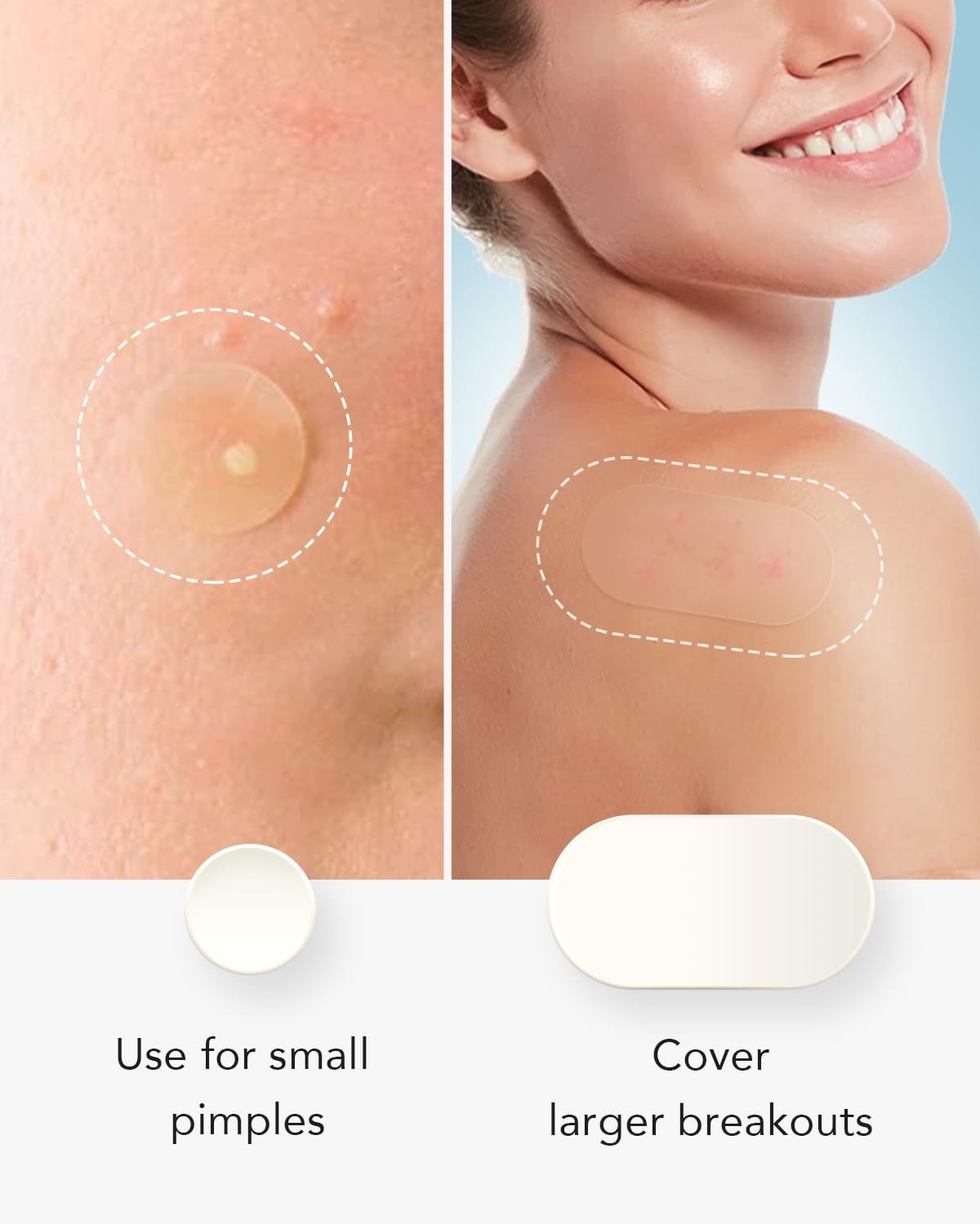 Large Acne Pimple Patches - 5 Sizes, 80 Count, Transparent