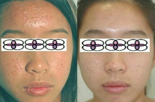 Glycolic Acid Face Cream for Acne and Scar Treatment - 10-70% Strength, 0.4oz
