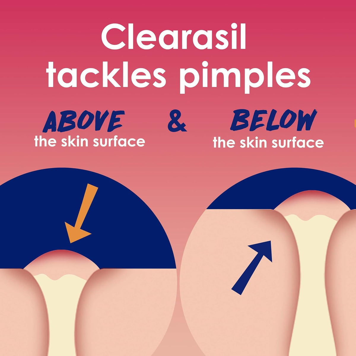 Deep Acne Treatment Pads with 2% Salicylic Acid for Fast Pimple Relief