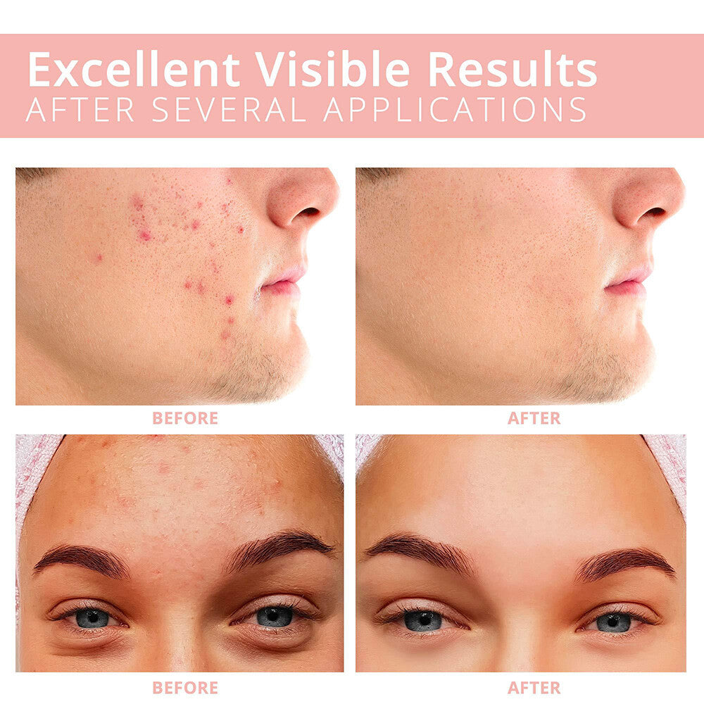 Hydrocolloid Acne Pimple Patches - Spot Treatment for Face & Scar Repair