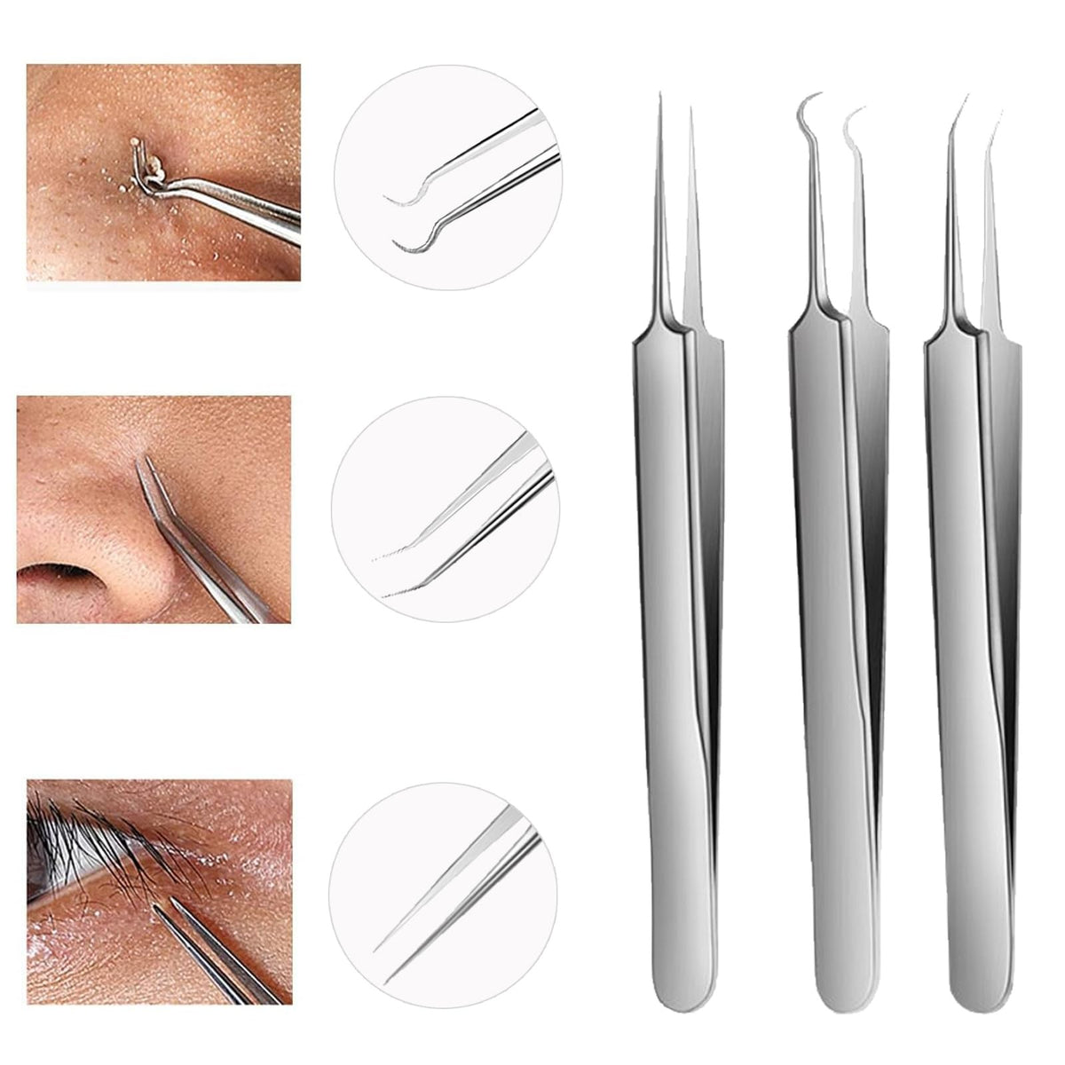 Blackhead Tweezers Set - 3 Stainless Steel Comedone Extractors for Acne & Pores