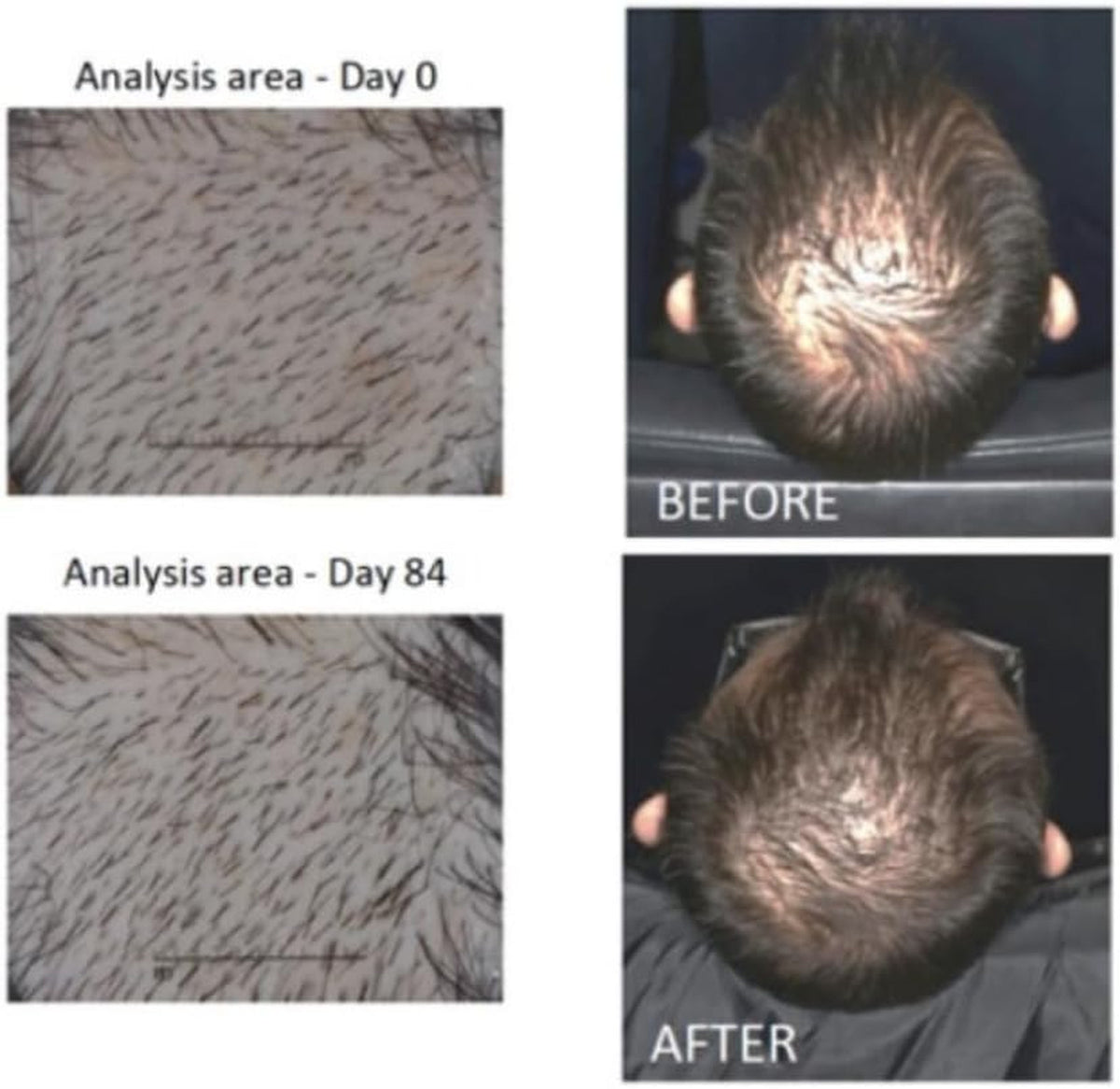 Hair Growth Serum with Redensyl for Thicker Fuller Stronger Reduce