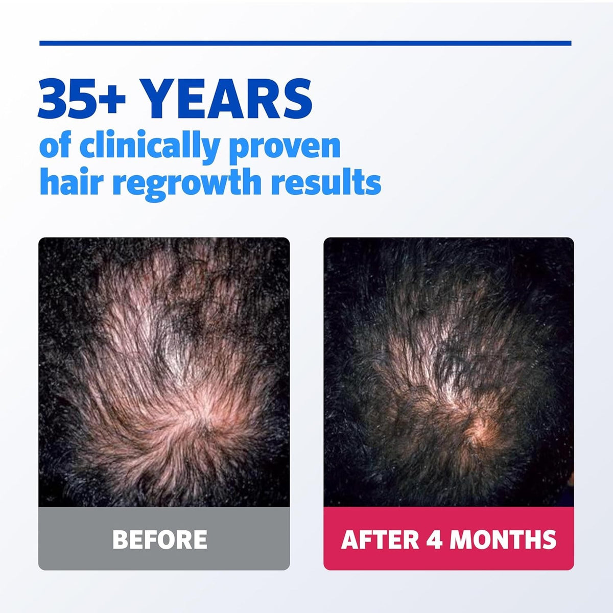 Minoxidil 5% Extra Strength Men's Hair Regrowth Treatment - 6 Month Supply