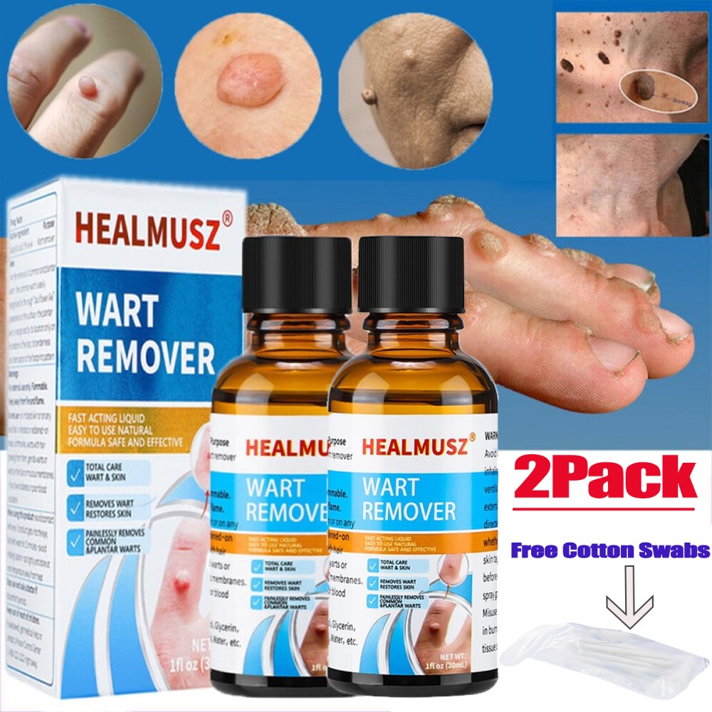 30ml Wart & Skin Tag Remover Liquid - Natural Herbal Formula for Foot & Body Warts