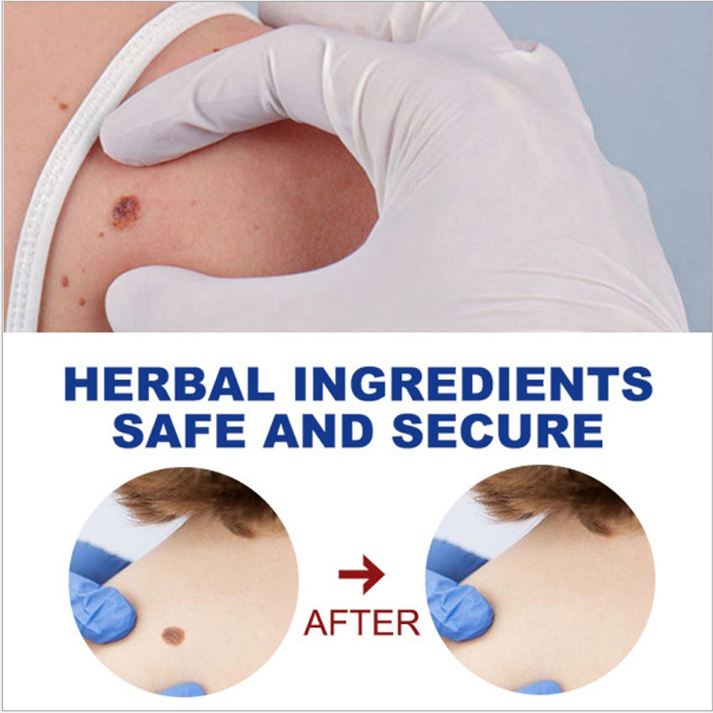 2-Pack 5ml Wart Removal Pen - Pain-Free Hand & Foot Wart Liquid