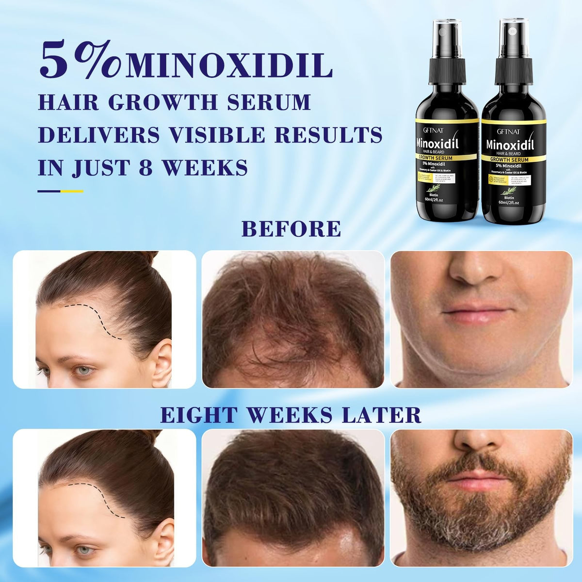 5% Minoxidil Spray for Hair Loss - Men & Women