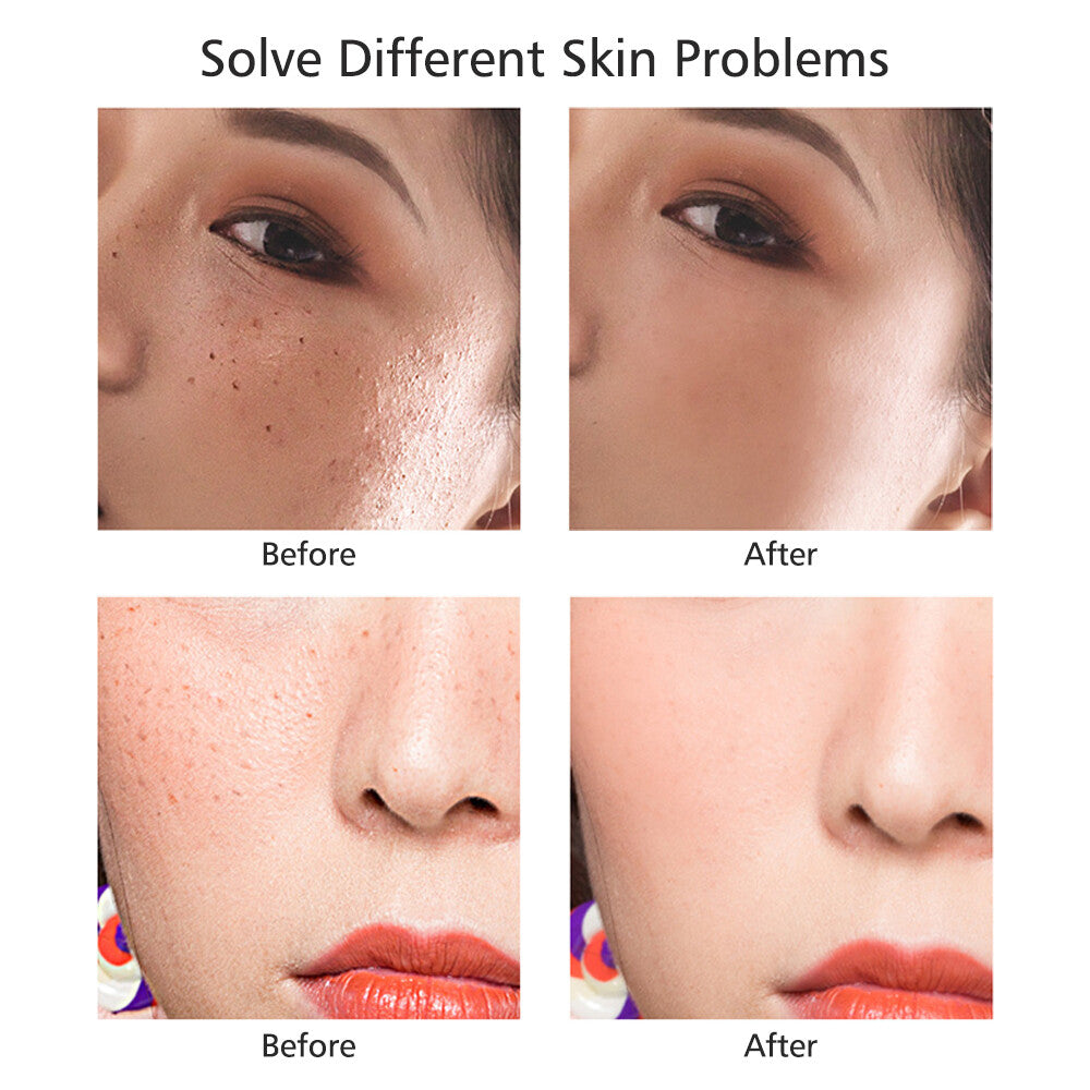 Wart & Skin Tag Remover Pen - Painless, Pimple & Mole Removal Device