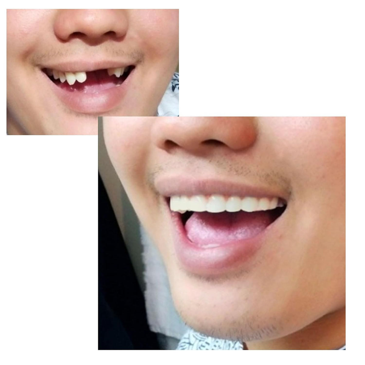 Comfort Fit Flex Natural Shade Teeth - Custom Fit Temporary Smile Enhancer