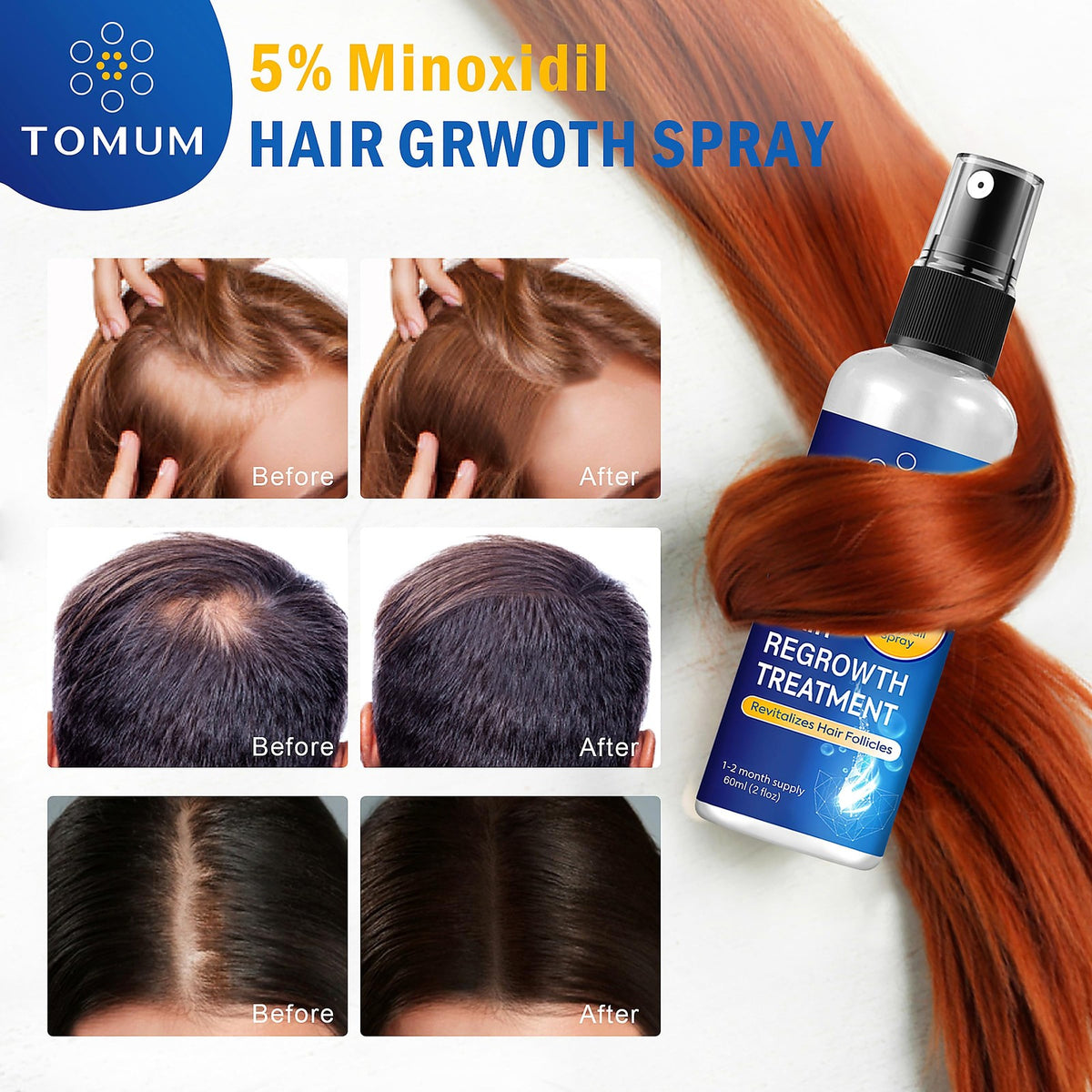 5% Minoxidil Topical Spray Hair Regrowth Treatment - 2 Pack