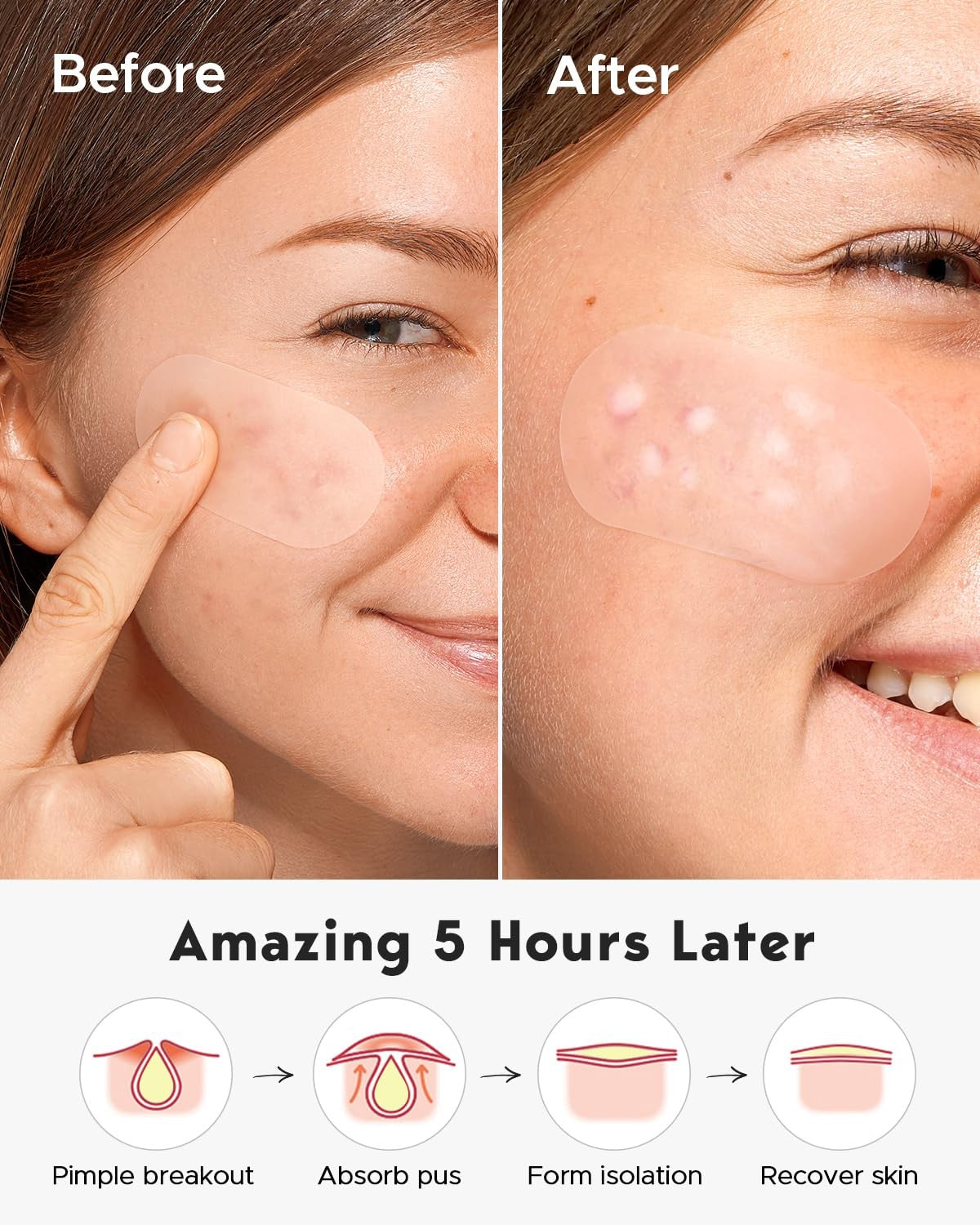 Large Acne Pimple Patches - 5 Sizes, 80 Count, Transparent