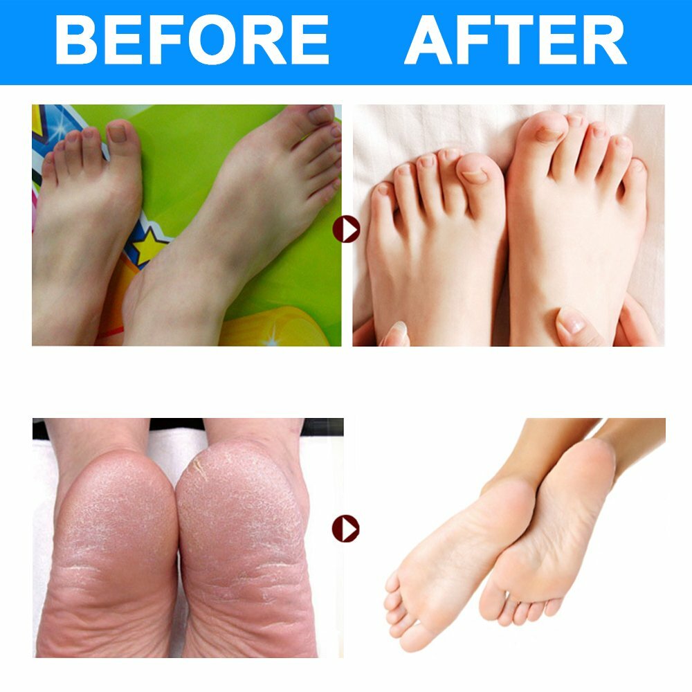 2-Pairs Foot Peel Masks for Soft Feet, Exfoliating Dead Skin & Callus