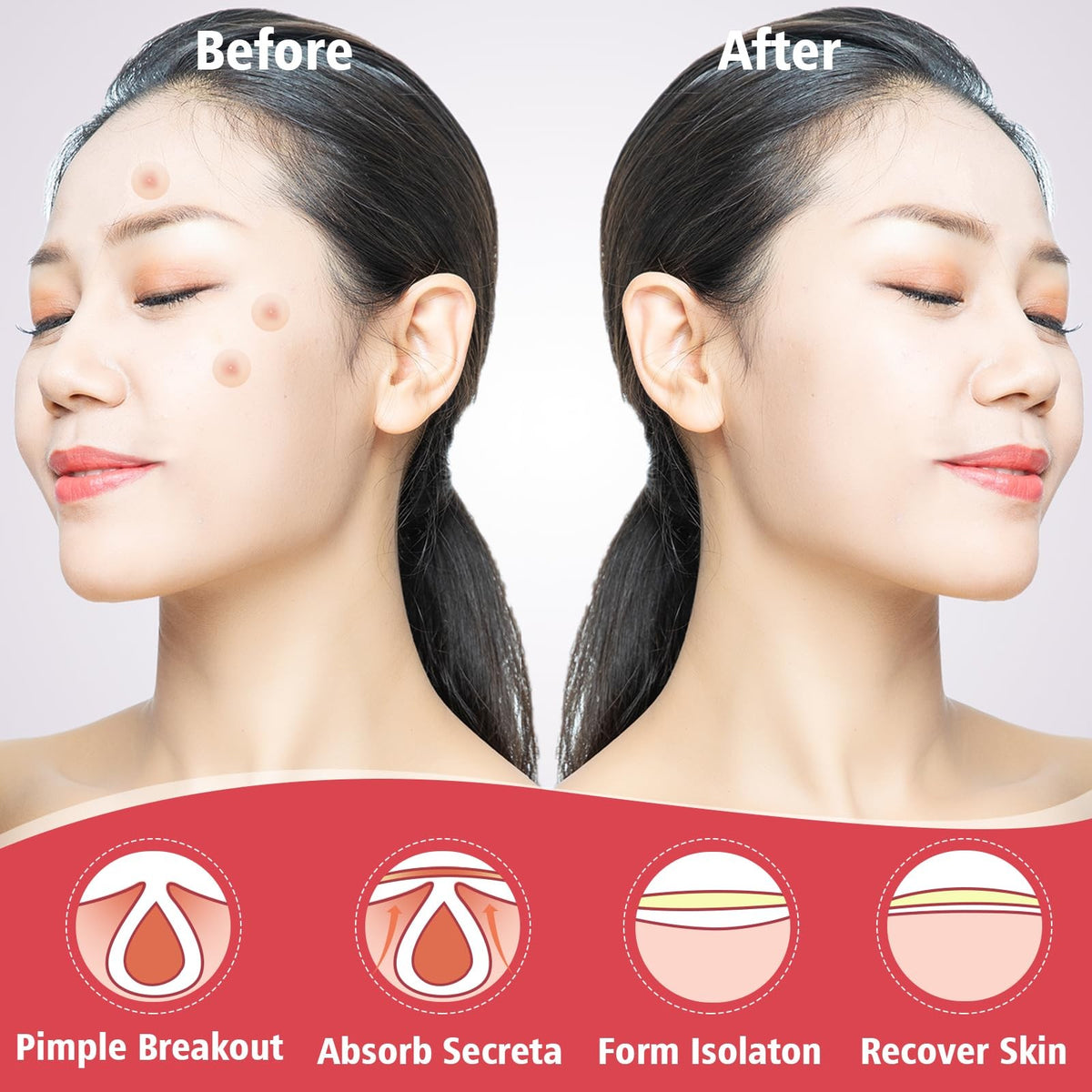 Acne Pimple Patches for Face, 450 Count - Hydrocolloid