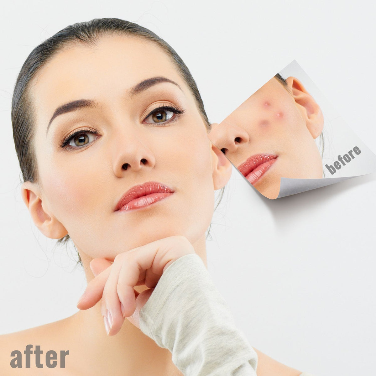 Professional Blackhead Extractor Set of 5 Skin Care Pimple Tools for Face & Body