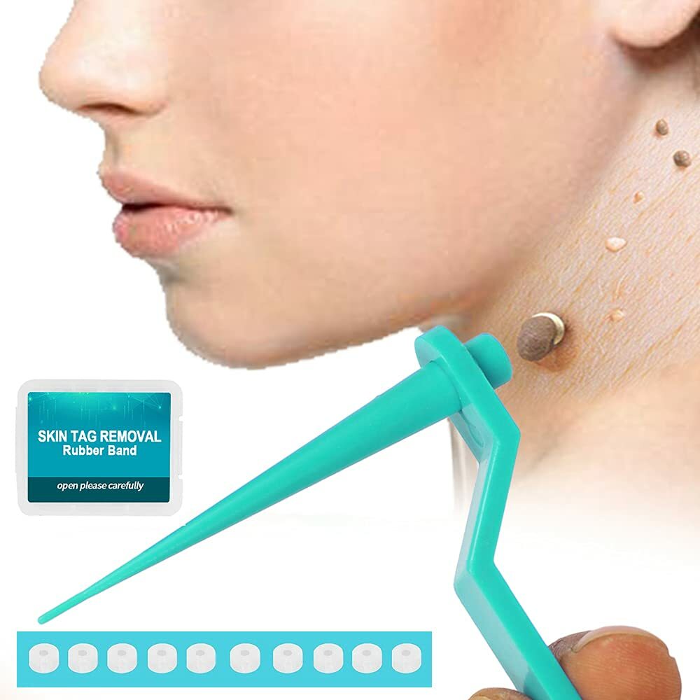 Skin Tag Remover Kit - Painless Wart & Acne Skin Tag Removal Device Set