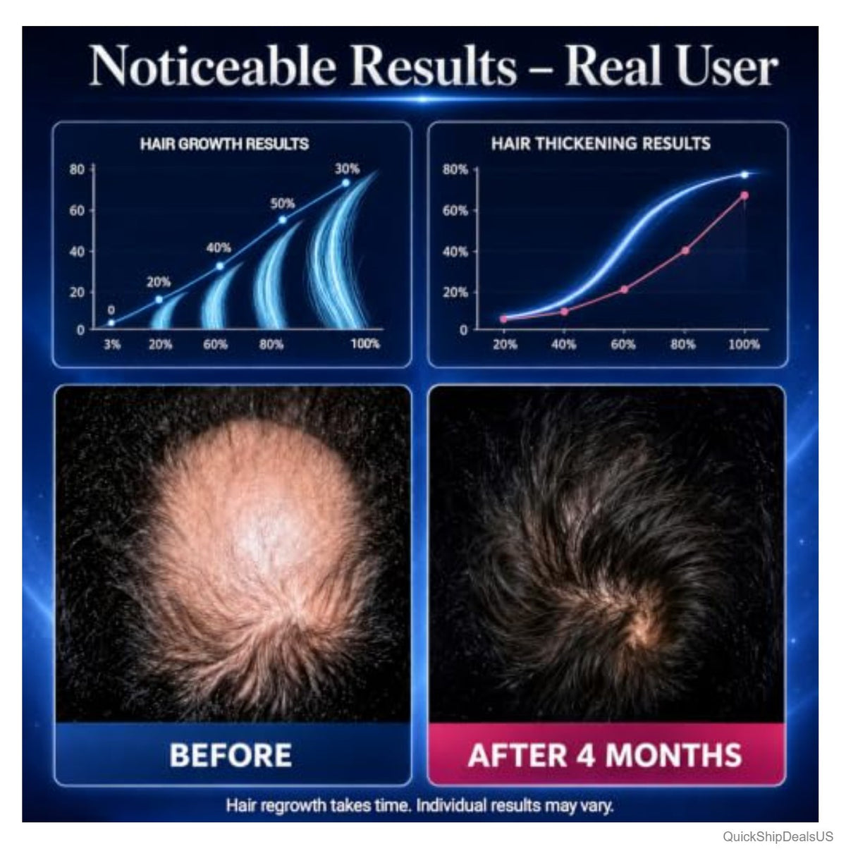 5% Minoxidil Foam For Hair Regrowth Men Women 160 mL 2 Bottles Scalp