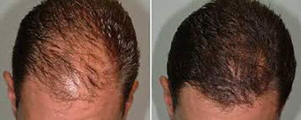 Hair Loss Treatment Shampoo - 16 Organic Oils for Men & Women