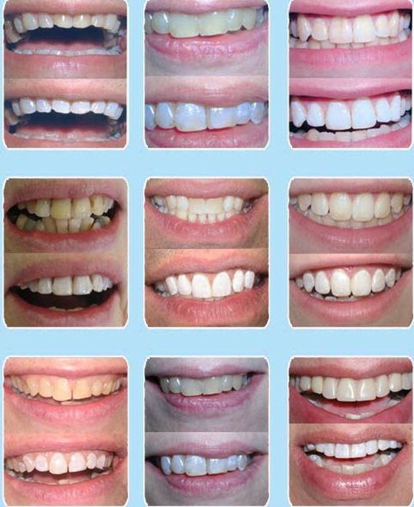 Pen Set - Hollywood White & Touch Up White for Artificial & Natural Teeth