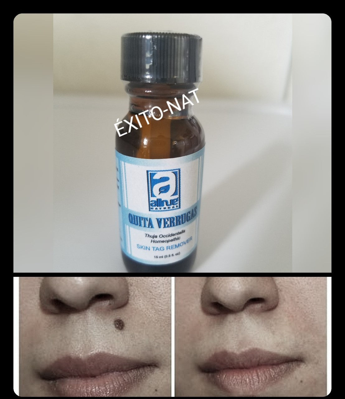 Natural Wart Remover - Fast Acting Salicylic Acid Formula, 15ml