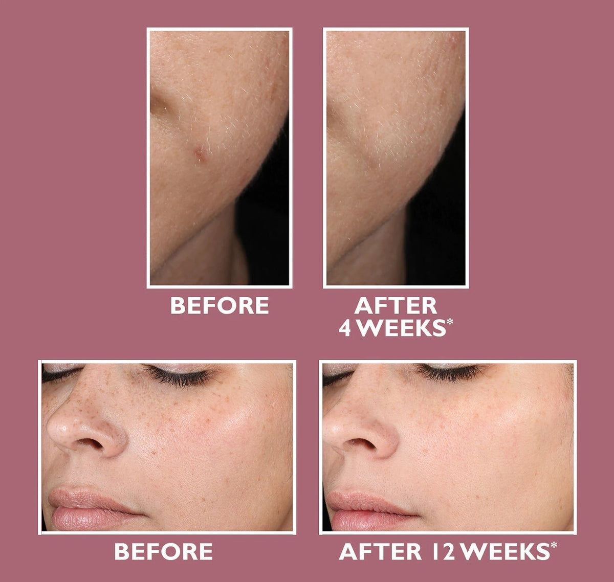 Niacinamide 10% Zinc 1% Hyaluronic Acid Serum for Oily Skin - Acne & Blemish Control