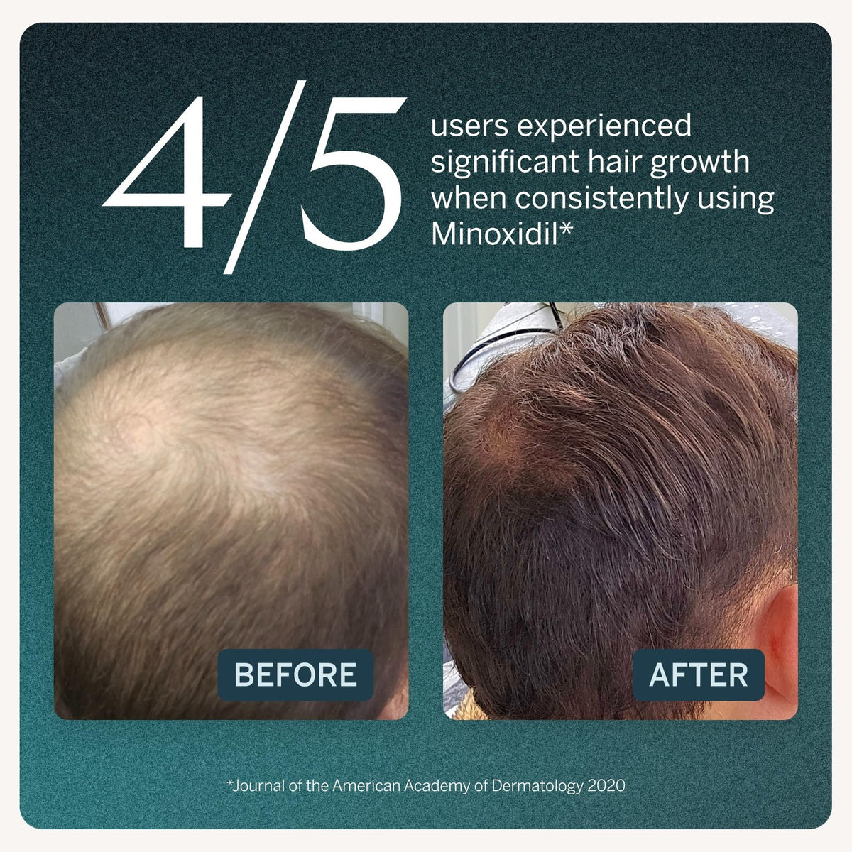 Minoxidil 5% Topical Hair Serum 0.67 Fl Oz - Pack of 3