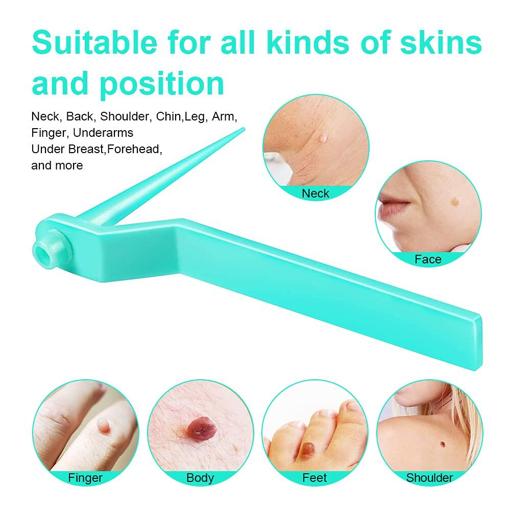 Skin Tag Remover Kit - Painless Wart & Acne Skin Tag Removal Device Set