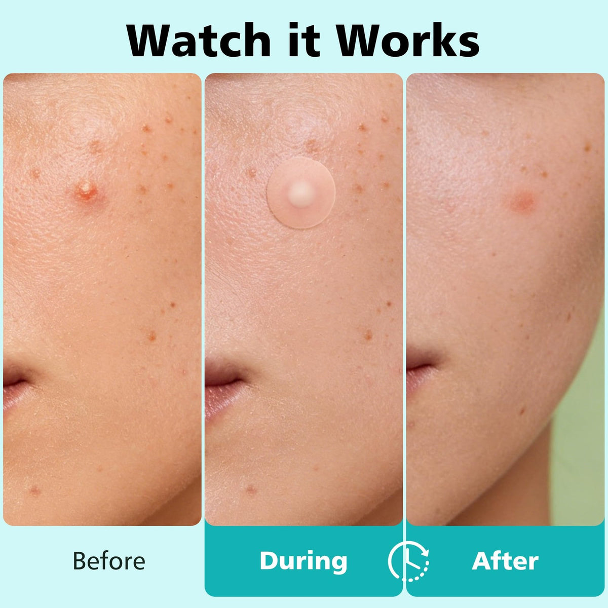 Hydrocolloid Acne Pimple Patches - 600 Count