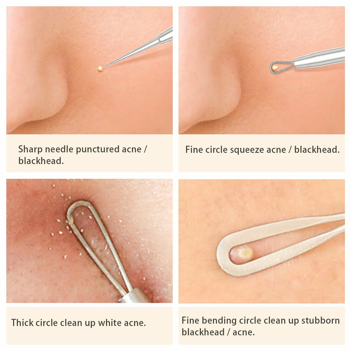 Blackhead & Acne Remover Pimple Comedone Extractor Tool Set - Stainless Steel