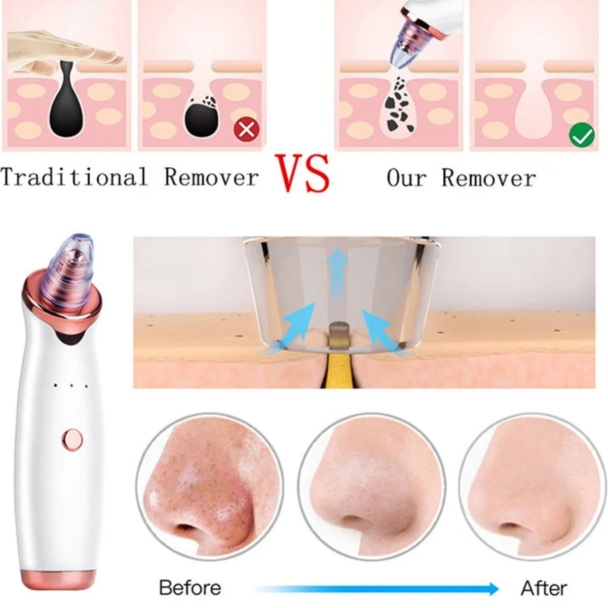 Blackhead Remover Vacuum for Pore Cleansing & Skin Rejuvenation