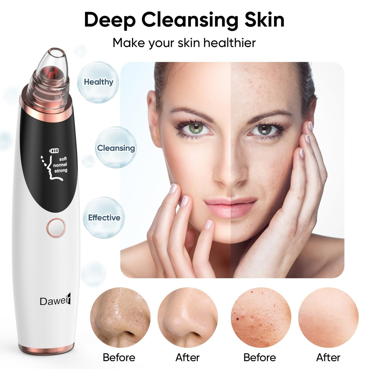 Blackhead Remover Pore Vacuum for Face & Nose with 3 Suction Levels