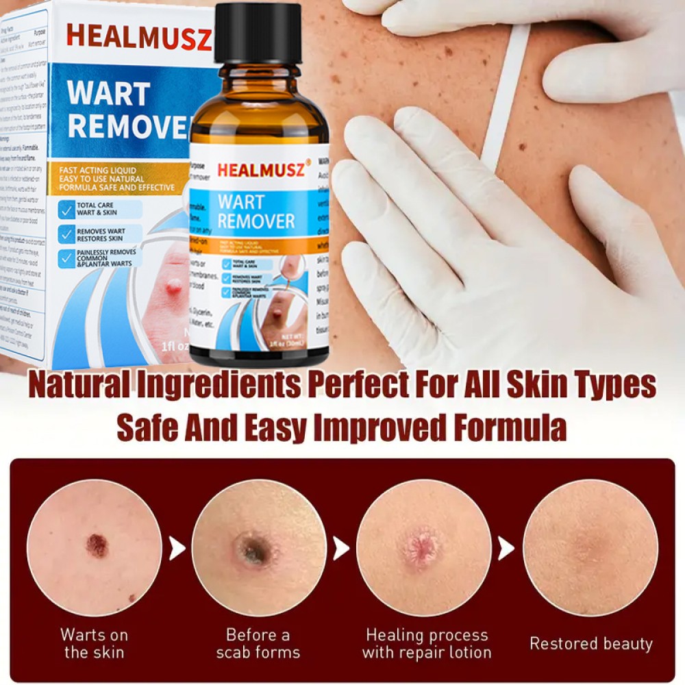 Wart Remover Liquid for Common and Plantar Warts - Natural Herbal Formula